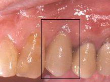 final_rest3 Final Post Operative Photograph