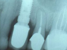 Post Operative X-ray