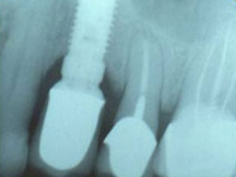 final_rest4 Post Operative X-ray