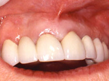 final_rest5 Pre-Operative Photograph