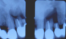 final_rest6 Pre-Operative X-rays