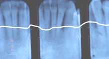 Bone Loss Example