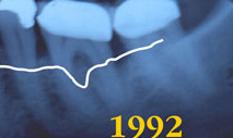 Bone Loss Example