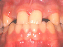 graft1 Bone deficiency before repair and implant placement