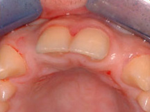 Bone deficiency before repair and implant placement