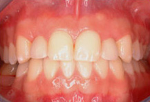 Case fully restored after soft tissue repair/implant placement