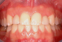 graft3 Case fully restored after soft tissue repair/implant placement