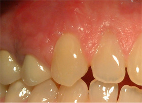 Post Tissue Augmentation