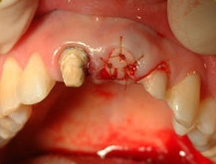 Dental Implant