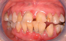 implant7 Pre-Operative Photo