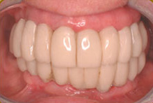 implant8 Two Week Post-Operative Photo