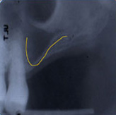 Sinus Lift X-ray