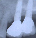 Sinus Lift X-ray