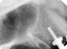 Sinus Lift X-ray