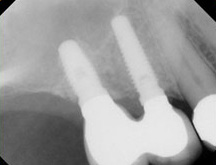 lift4 Sinus Lift X-ray