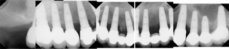 panoramic_xray2 Post-Op X-rays