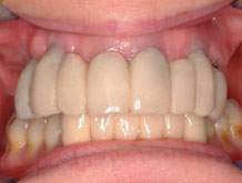 post_op_temp Post-Op Fixed Temporaries for Full Arch Case